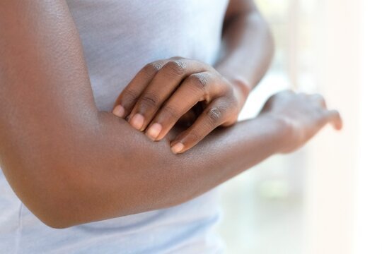 Batana Oil and Psoriasis, Eczema